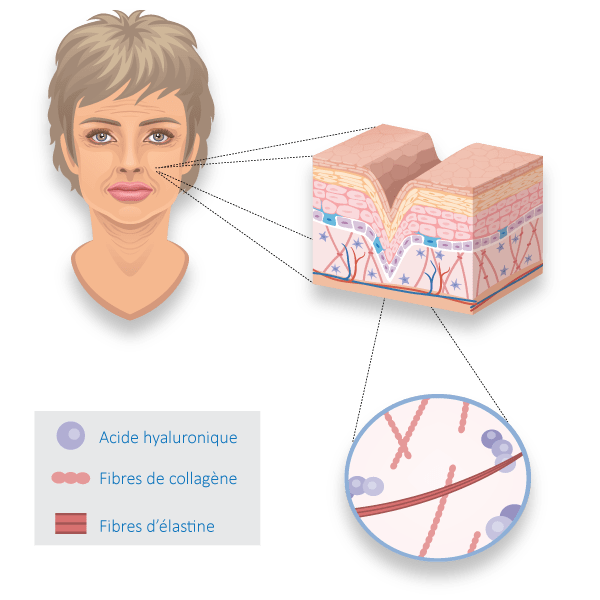Illustration d'une peau de visage âgée et des soins de médecine esthétique à Lille Villeneuve d'Ascq du docteur Sar
