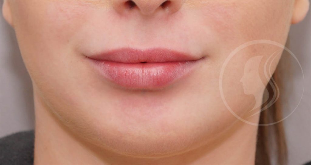 Photo de lèvres après injection d'acide hyaluronique