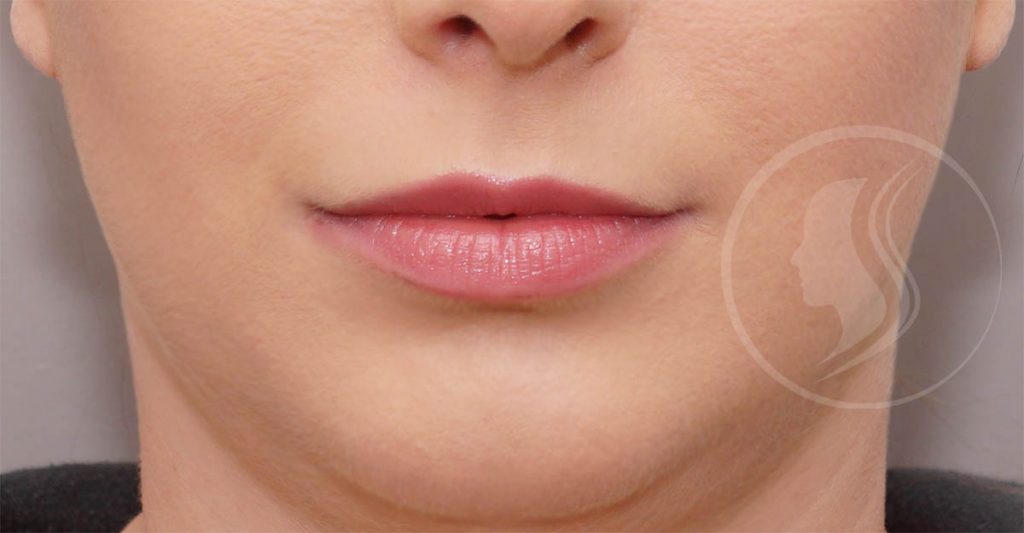 Photo de lèvres avant injection d'acide hyaluronique