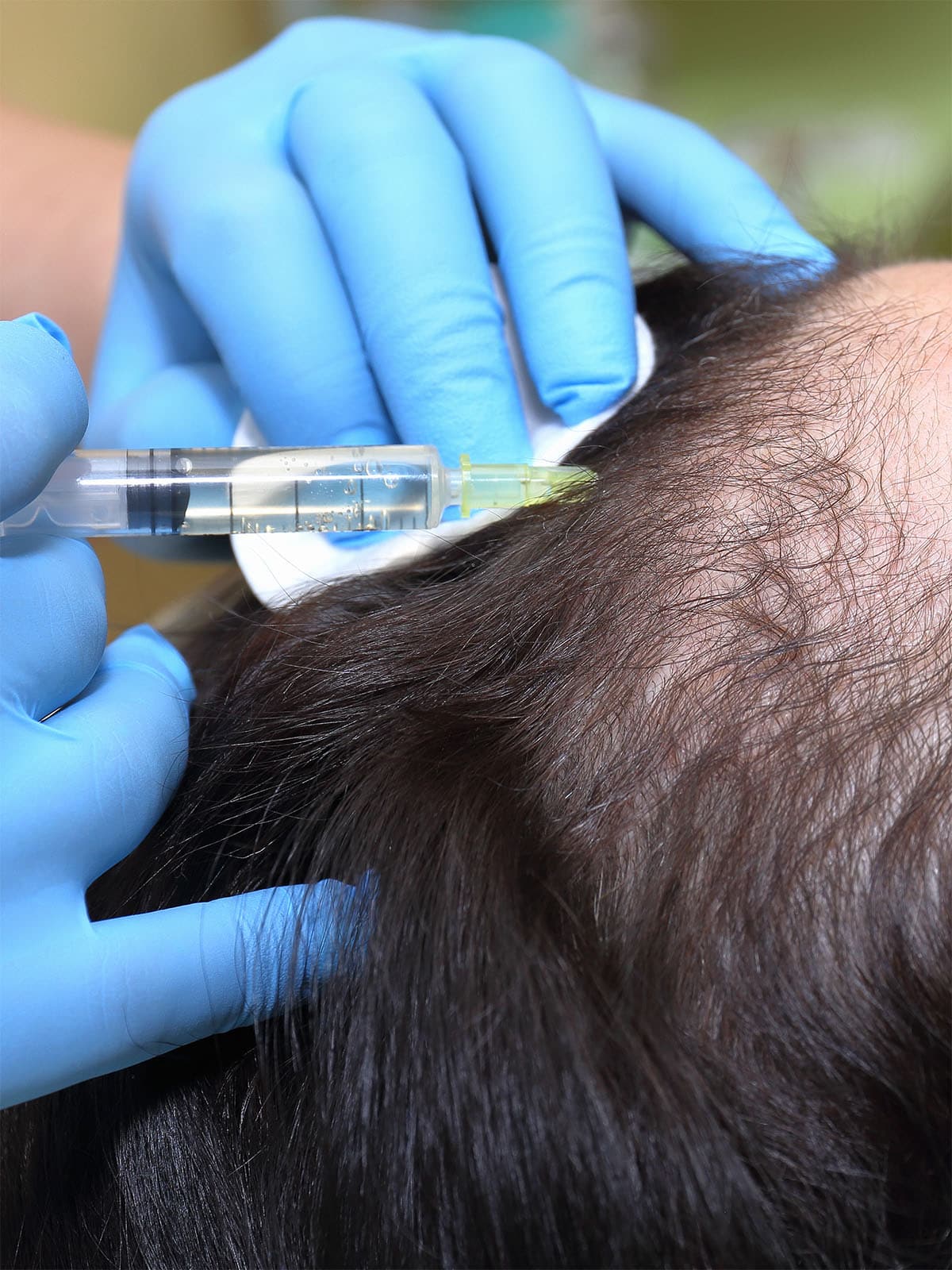 Soin de mésothérapie du cuir chevelu contre la chute de cheveux par PRP