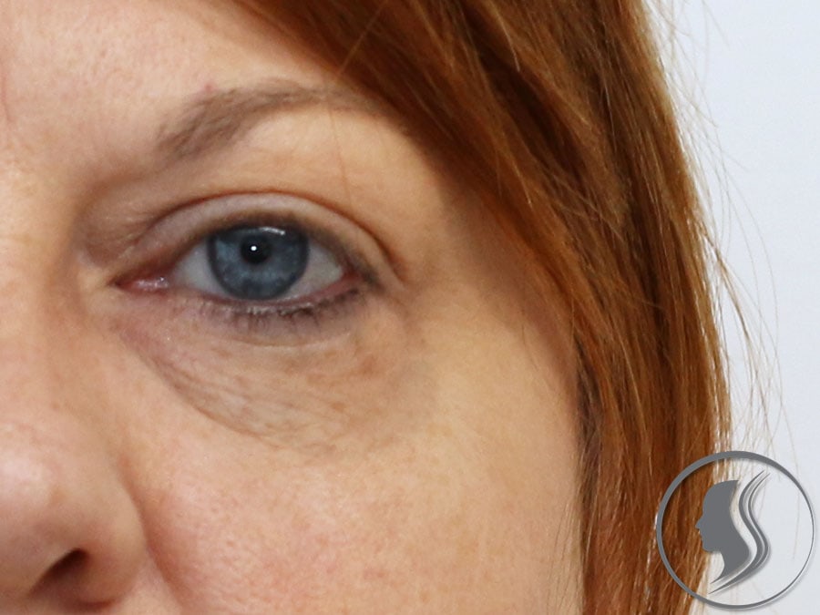 avant injection d'acide hyaluronique