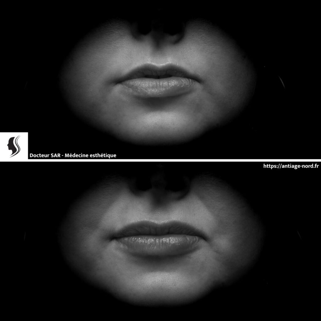 Injection d'acide hyaluronique lèvres avant et après 1