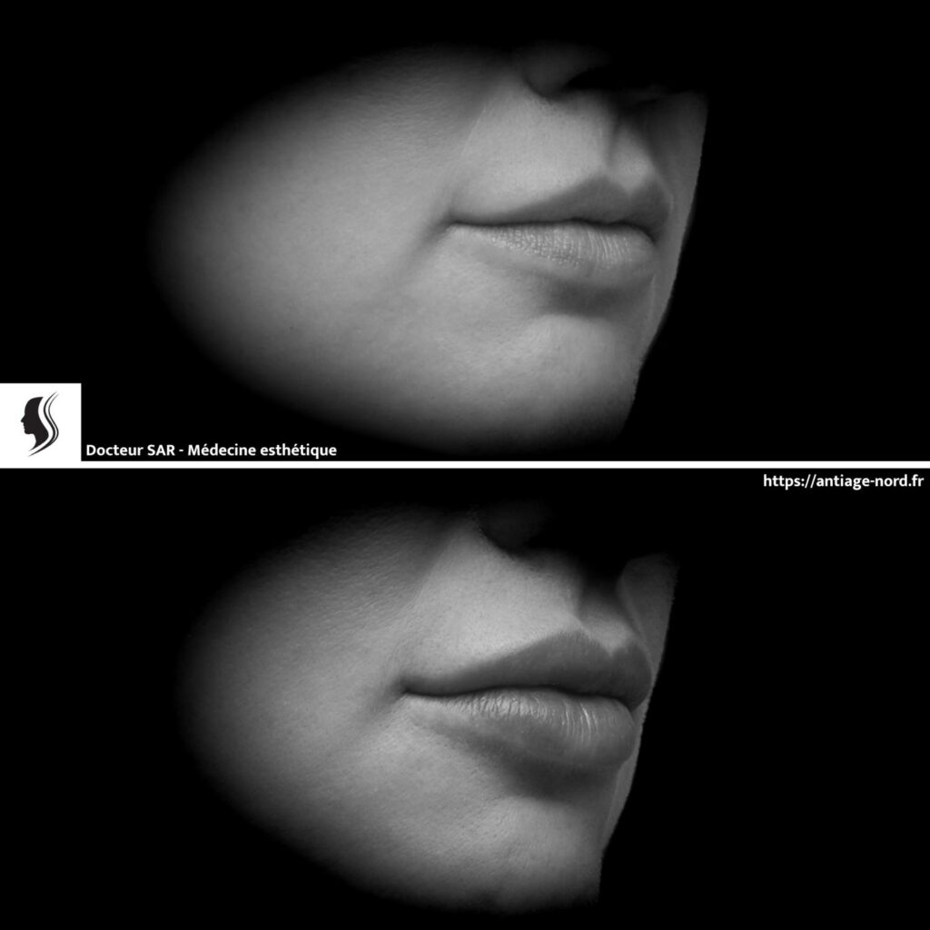 Photo de lèvres avant et après injection d'acide hyaluronique pour les repulper à Lille Villeneuve d'Ascq