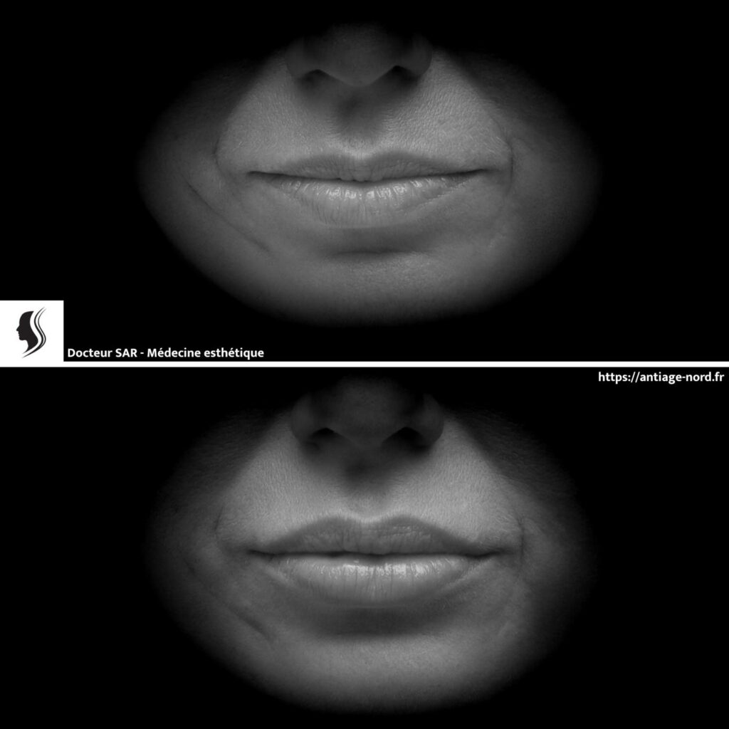 Injection d'acide hyaluronique lèvres avant et après 8