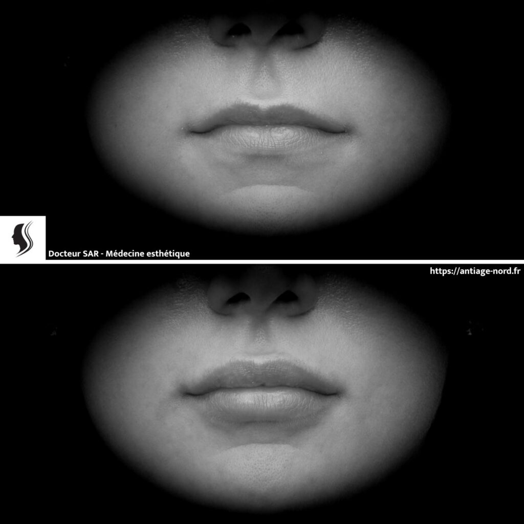 Injection d'acide hyaluronique lèvres avant et après 2