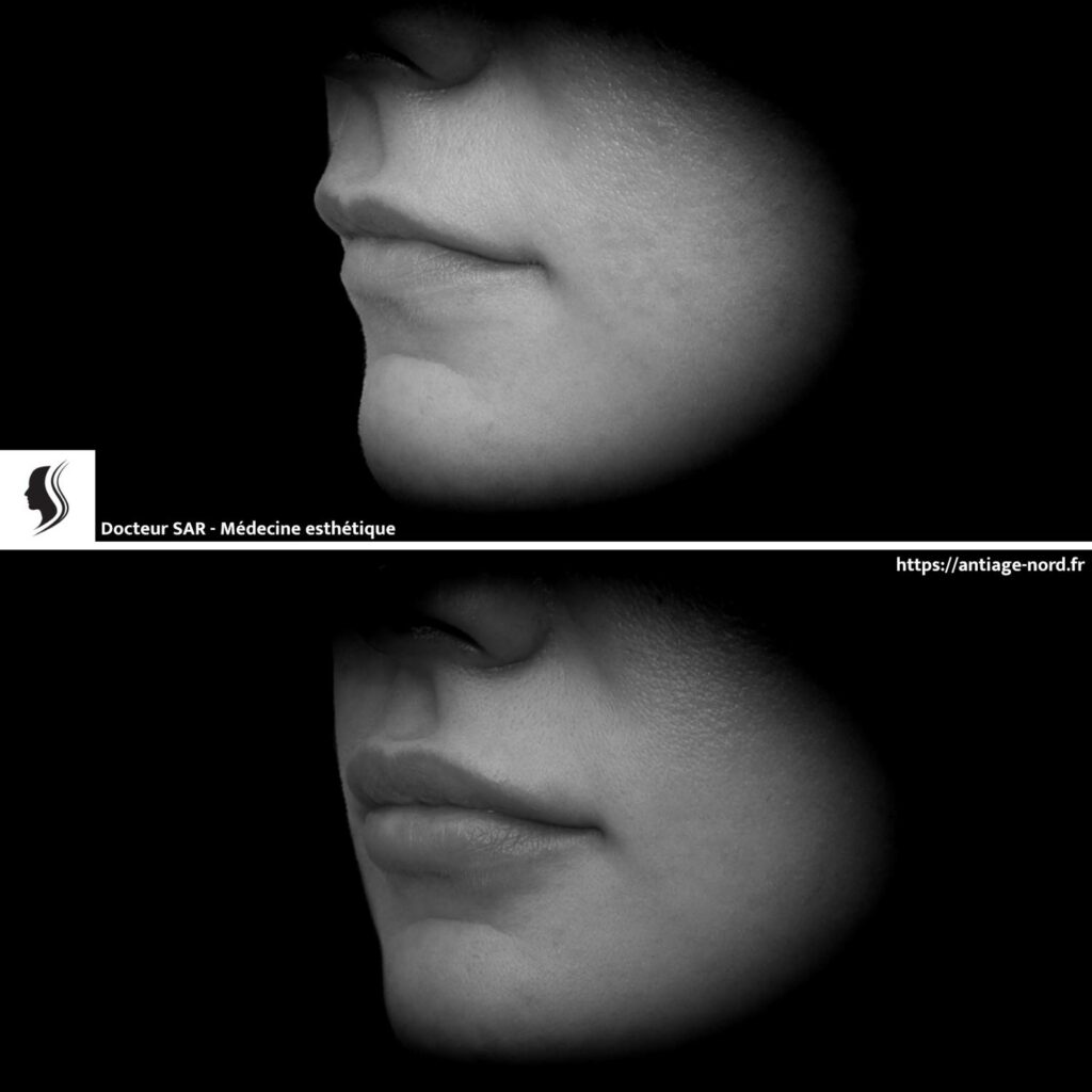 Injection d'acide hyaluronique lèvres avant et après 3
