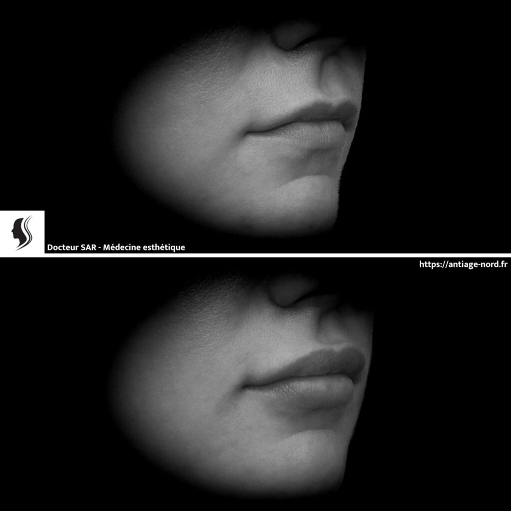 Injection d'acide hyaluronique lèvres avant et après 9