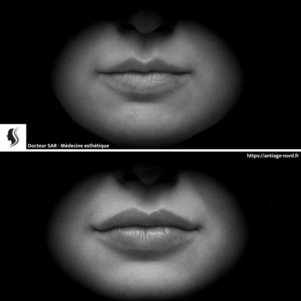 Photo de lèvres avant et après injection d'acide hyaluronique pour les repulper à Lille Villeneuve d'Ascq