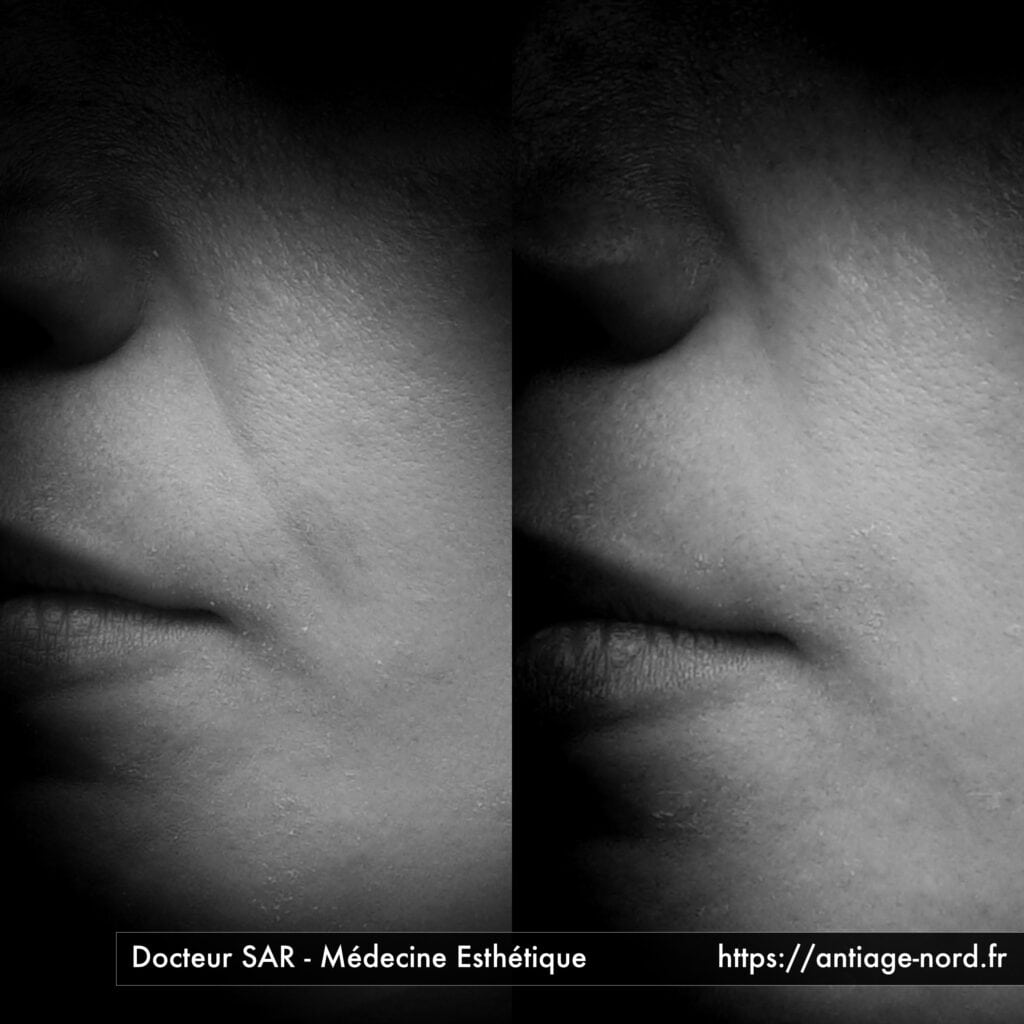 Comblement de sillon nasogénien avant et après par le docteur Sar à Lille Villeneuve d'Ascq