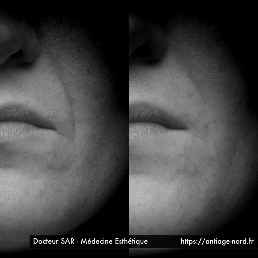 Comblement de sillon nasogénien avant et après par le docteur Sar à Lille Villeneuve d'Ascq